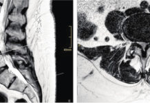 Mal di schiena e sciatica negli anziani: cause, sintomi e terapie