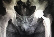 Artrosi dell’Anca o Coxartrosi