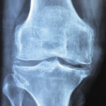 knee-1406964_1920_opt