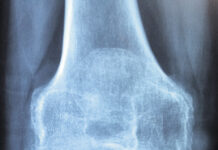 La dieta contro l’osteoporosi